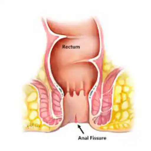 Anal Fissures Treatment & Surgery in Kanpur