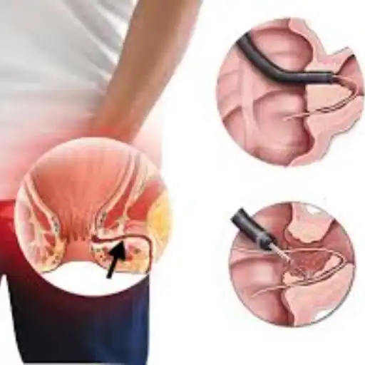 Best Fistula Surgeon in Kanpur