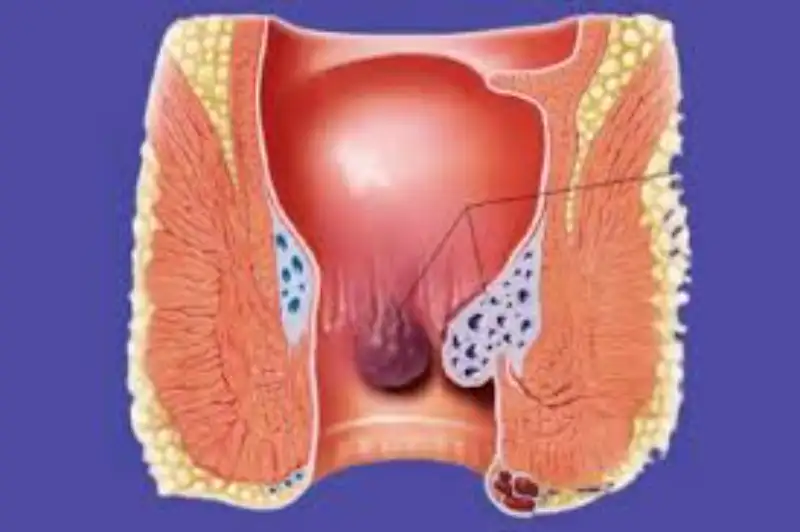 Piles Treatment & Laser Surgery in Kanpur