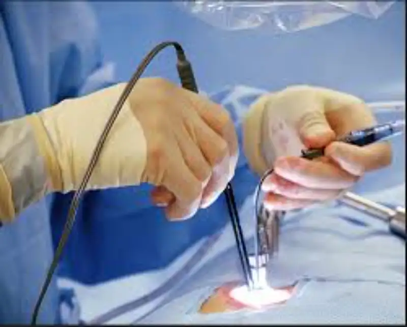 Anal Fistula Laser Treatment in Kanpur